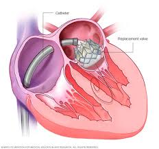 Intracoronary Physiology FFR